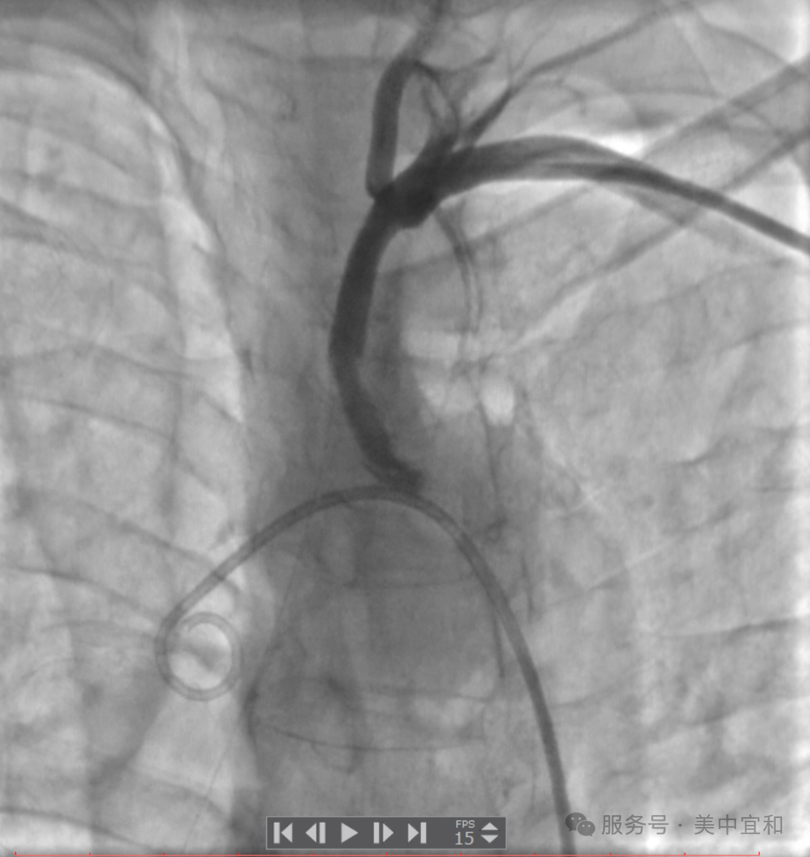 头晕、手臂无力，两臂血压差值大于 30 mmHg，警惕锁骨下动脉在「盗血」