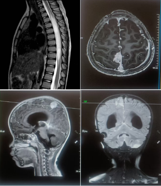 京昆神经肿瘤 MDT 远程会诊，破解滇中儿童脑肿瘤诊疗难题
