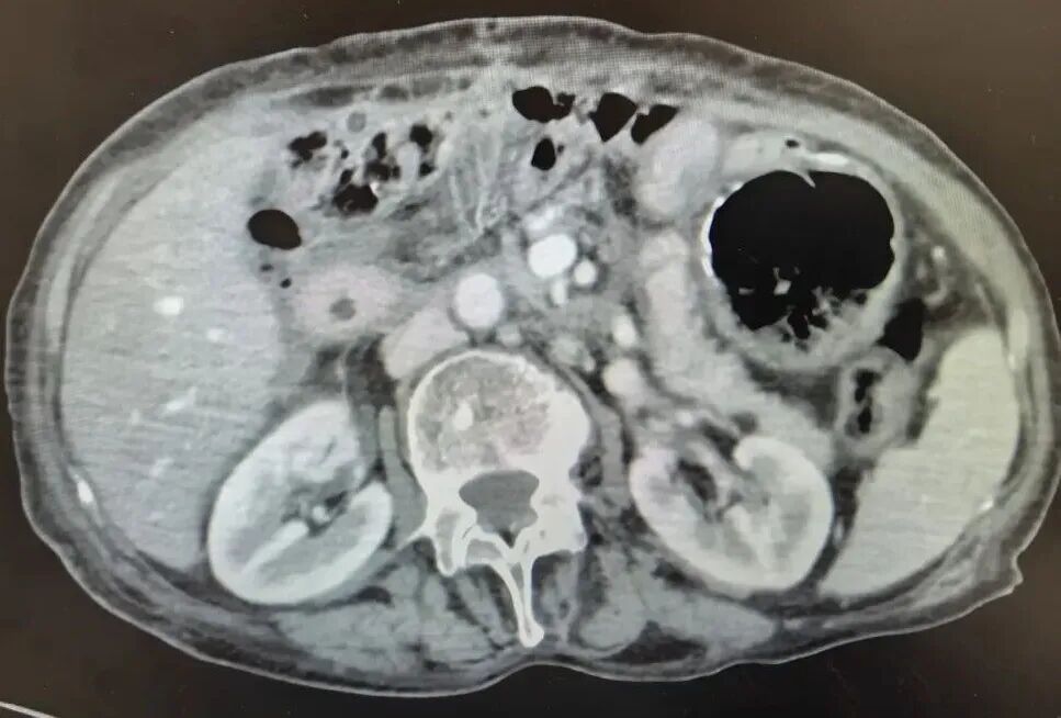 昆明三博普外科团队勇攀腹部外科手术「珠峰」,成功实施胰十二指肠切除术