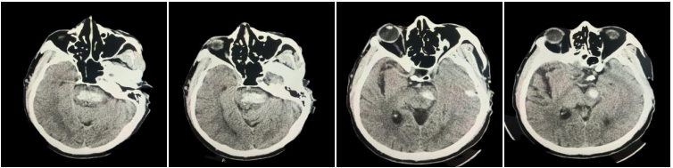 中西医并重，突破「生命禁区」！长治市中医医院成功救治重症脑干出血患者