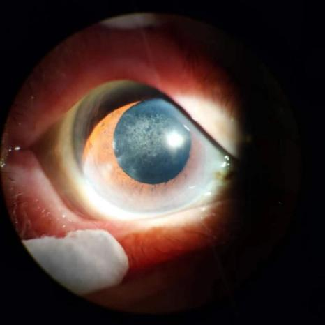 什么是后发性白内障？武汉普瑞眼科程旭康讲解术后视力模糊的原因