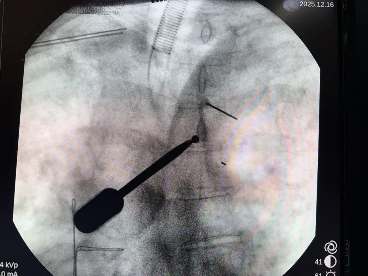 医院动态丨粤喀联手破难题  喀地一院首例 UBE 微创治疗胸椎椎管内肿瘤成功实施