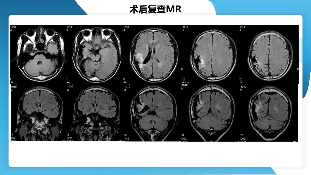《「痫停」信步》癫痫治疗病例荟萃第四十四期---颞前叶及脑软化灶切除治疗难治性癫痫一例
