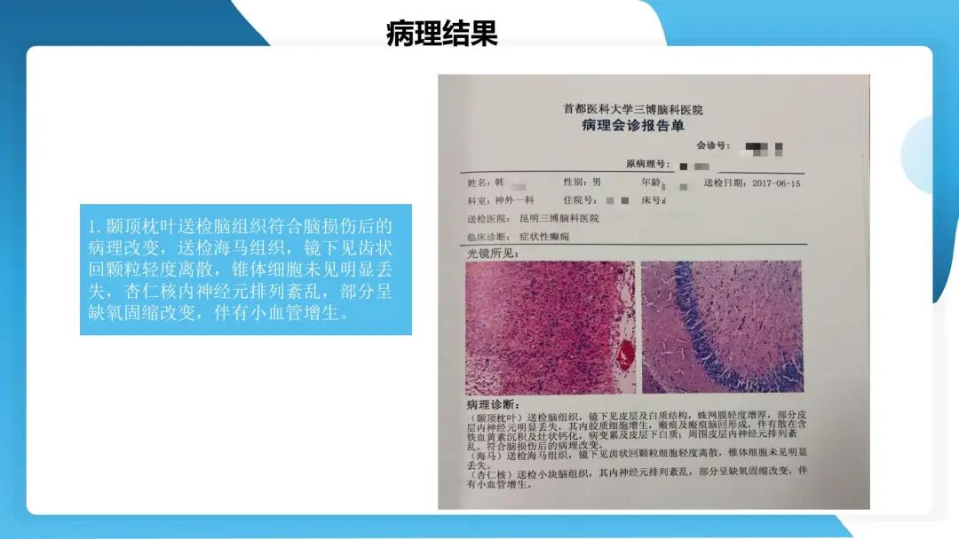 《「痫停」信步》癫痫治疗病例荟萃第四十四期---颞前叶及脑软化灶切除治疗难治性癫痫一例