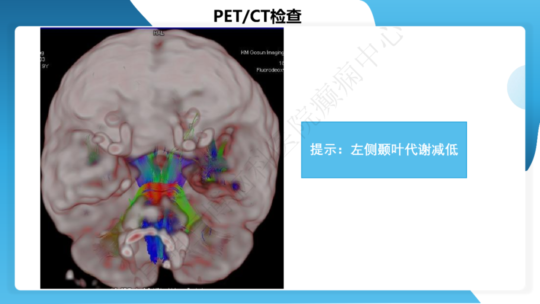 《「痫停」信步》癫痫治疗病例荟萃第四十三期---左侧颞前叶及内侧结构切除手术治疗局灶性癫痫一列