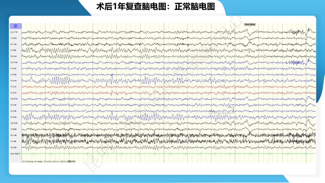 《「痫停」信步》癫痫治疗病例荟萃第四十三期---左侧颞前叶及内侧结构切除手术治疗局灶性癫痫一列