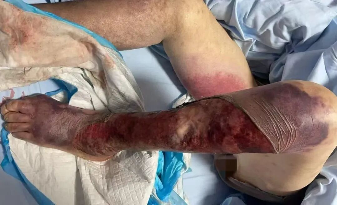 重磅 | 熊建伟正式加入正兴医院，专攻皮肤疑难痼疾！