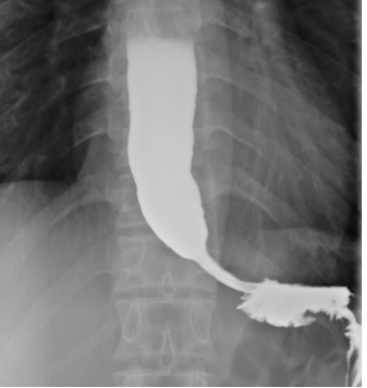 吞咽障碍 2 年，竟查出「鸟嘴样」食管！浙大四院消化内科 POEM 手术精准「解锁」