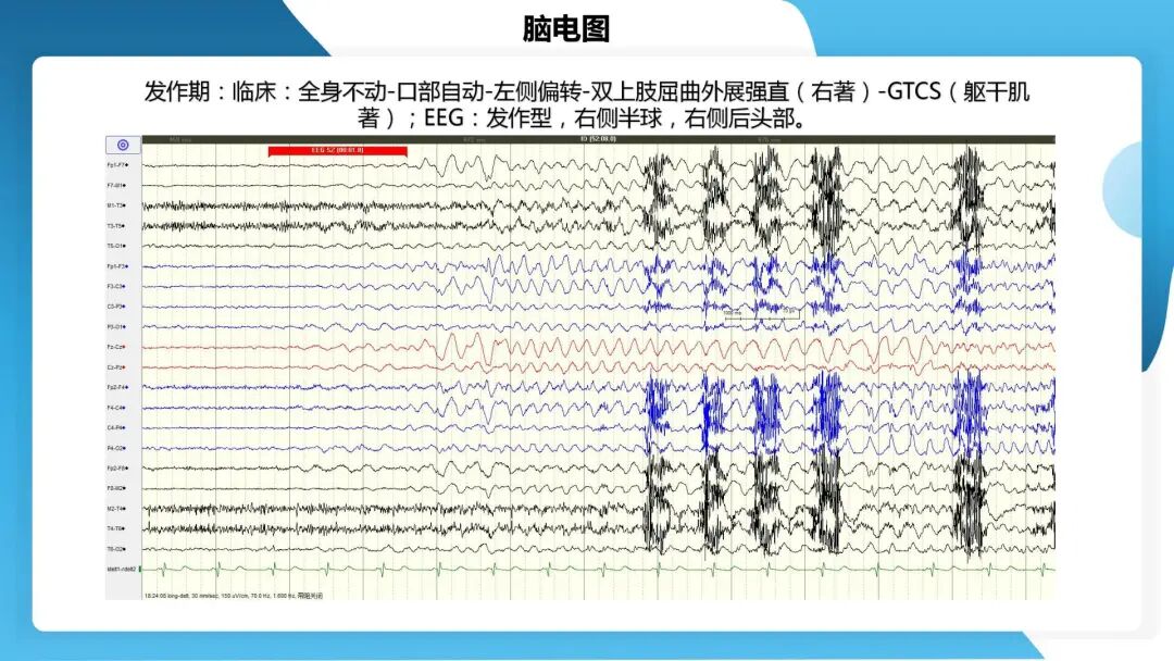 《「痫停」信步》癫痫治疗病例荟萃第四十四期---颞前叶及脑软化灶切除治疗难治性癫痫一例