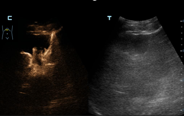 精准「声」导，打通生命通道：南大二附院超声介入团队完成一例高难度 PTCD 置管
