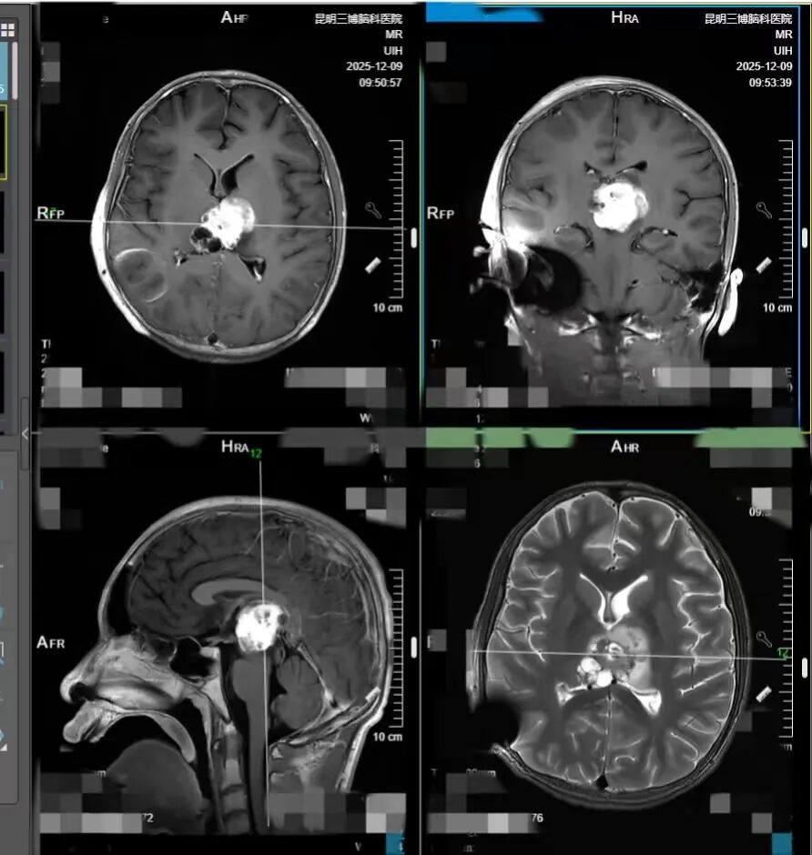 13 岁男孩确诊脑癌到昏迷仅 13 天！几个月前就有症状，很多人忽视了