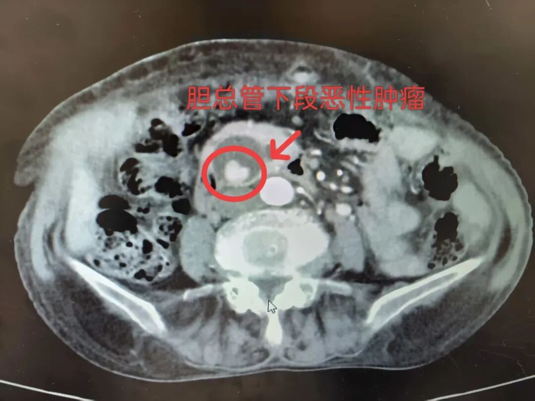 昆明三博普外科团队勇攀腹部外科手术「珠峰」,成功实施胰十二指肠切除术