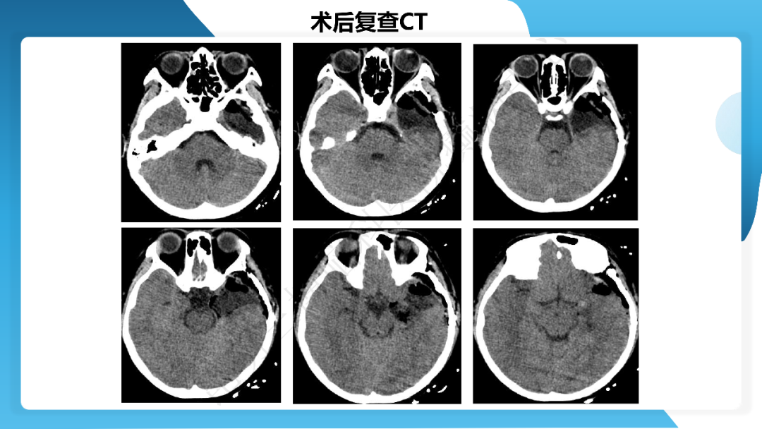 《「痫停」信步》癫痫治疗病例荟萃第四十三期---左侧颞前叶及内侧结构切除手术治疗局灶性癫痫一列