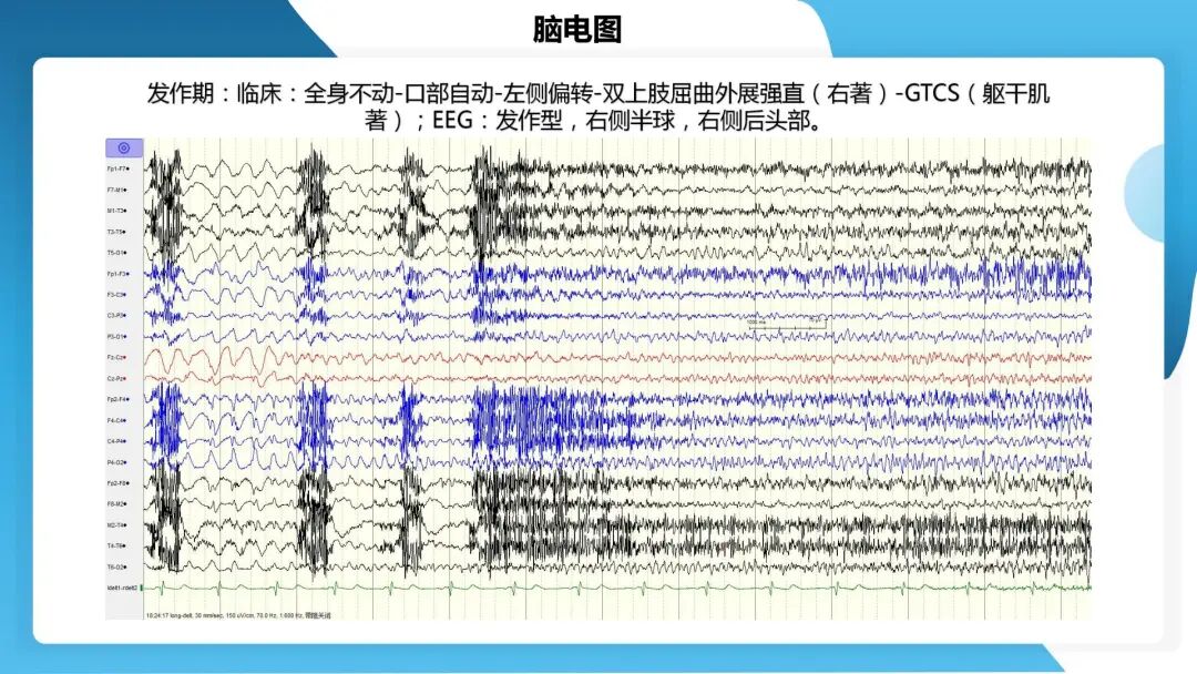 《「痫停」信步》癫痫治疗病例荟萃第四十四期---颞前叶及脑软化灶切除治疗难治性癫痫一例