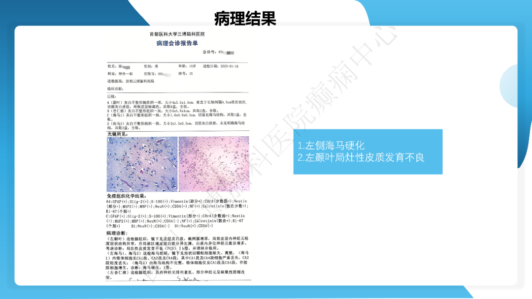 《「痫停」信步》癫痫治疗病例荟萃第四十三期---左侧颞前叶及内侧结构切除手术治疗局灶性癫痫一列