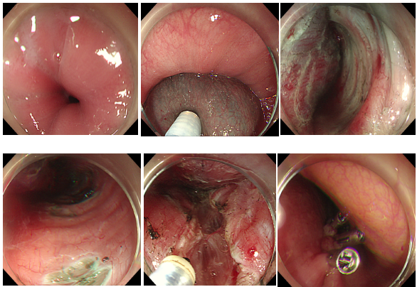 吞咽障碍 2 年，竟查出「鸟嘴样」食管！浙大四院消化内科 POEM 手术精准「解锁」