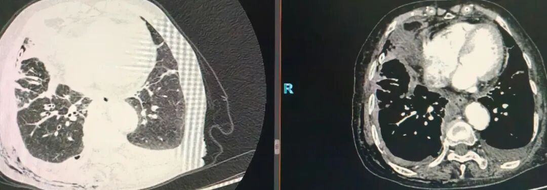 耄耋老人胸闷气短缠身,多学科协作+内科胸腔镜术解病痛