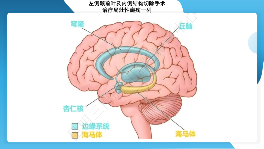 《「痫停」信步》癫痫治疗病例荟萃第四十三期---左侧颞前叶及内侧结构切除手术治疗局灶性癫痫一列