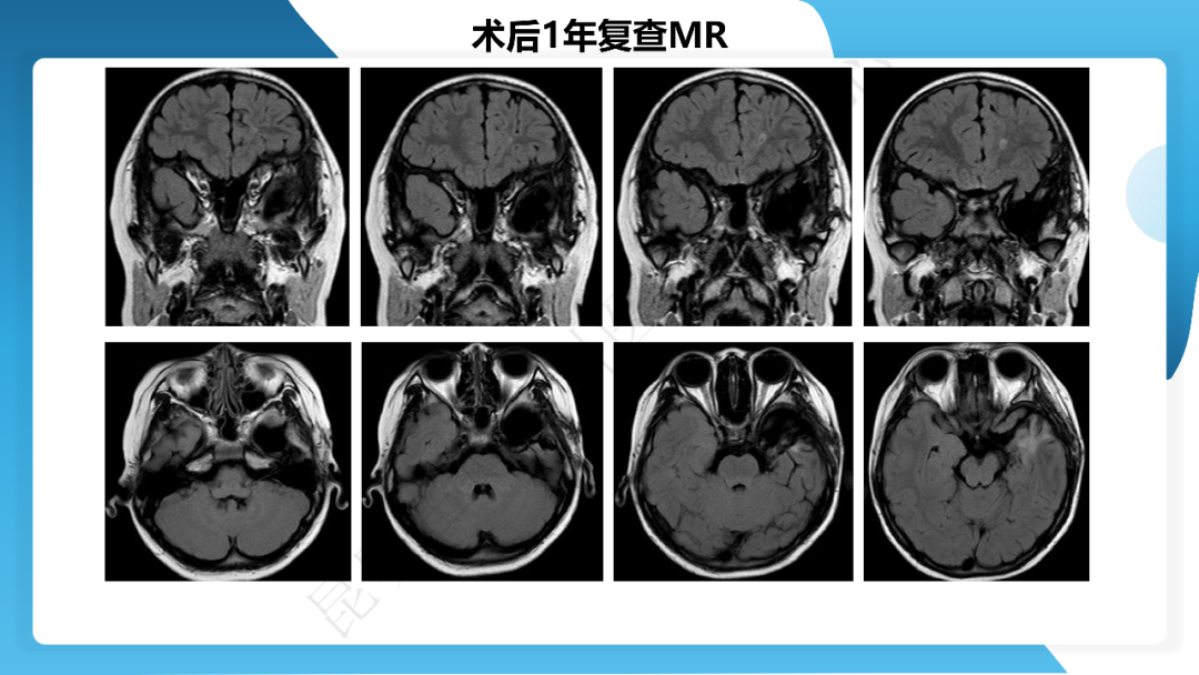《「痫停」信步》癫痫治疗病例荟萃第四十三期---左侧颞前叶及内侧结构切除手术治疗局灶性癫痫一列