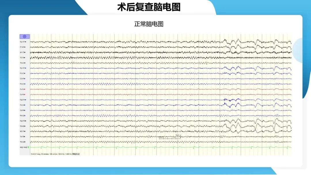 《「痫停」信步》癫痫治疗病例荟萃第四十四期---颞前叶及脑软化灶切除治疗难治性癫痫一例