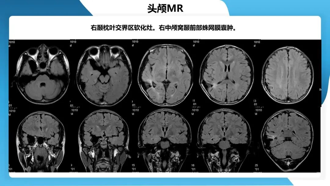 《「痫停」信步》癫痫治疗病例荟萃第四十四期---颞前叶及脑软化灶切除治疗难治性癫痫一例