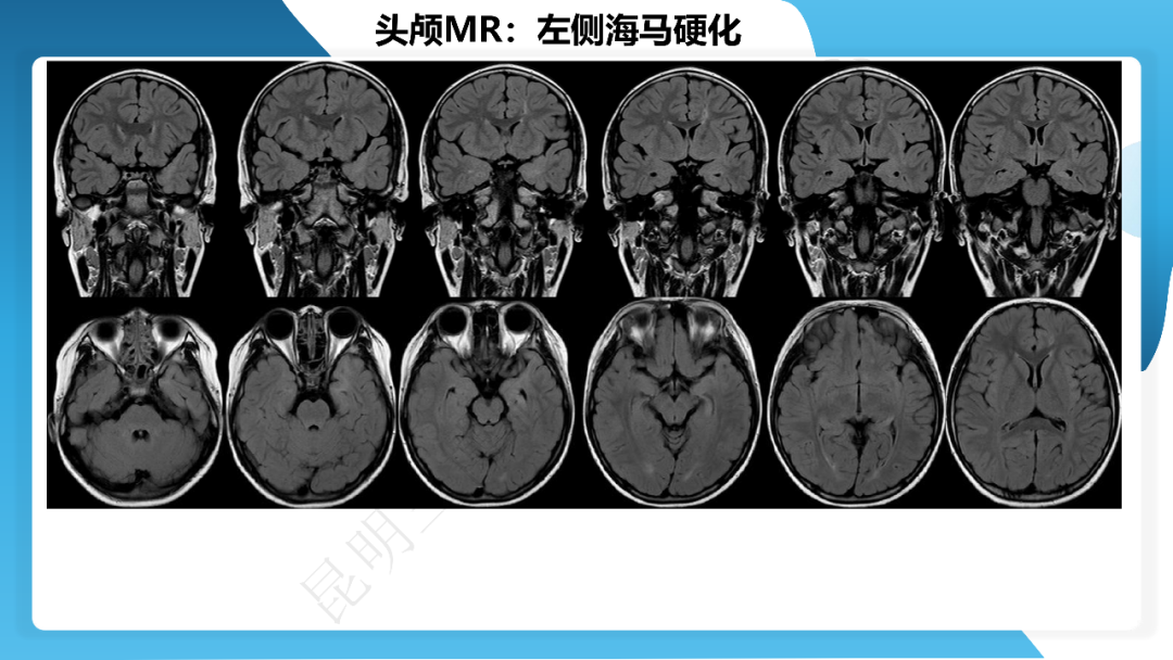 《「痫停」信步》癫痫治疗病例荟萃第四十三期---左侧颞前叶及内侧结构切除手术治疗局灶性癫痫一列