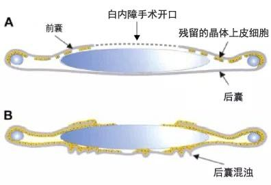 什么是后发性白内障？武汉普瑞眼科程旭康讲解术后视力模糊的原因