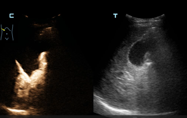精准「声」导，打通生命通道：南大二附院超声介入团队完成一例高难度 PTCD 置管