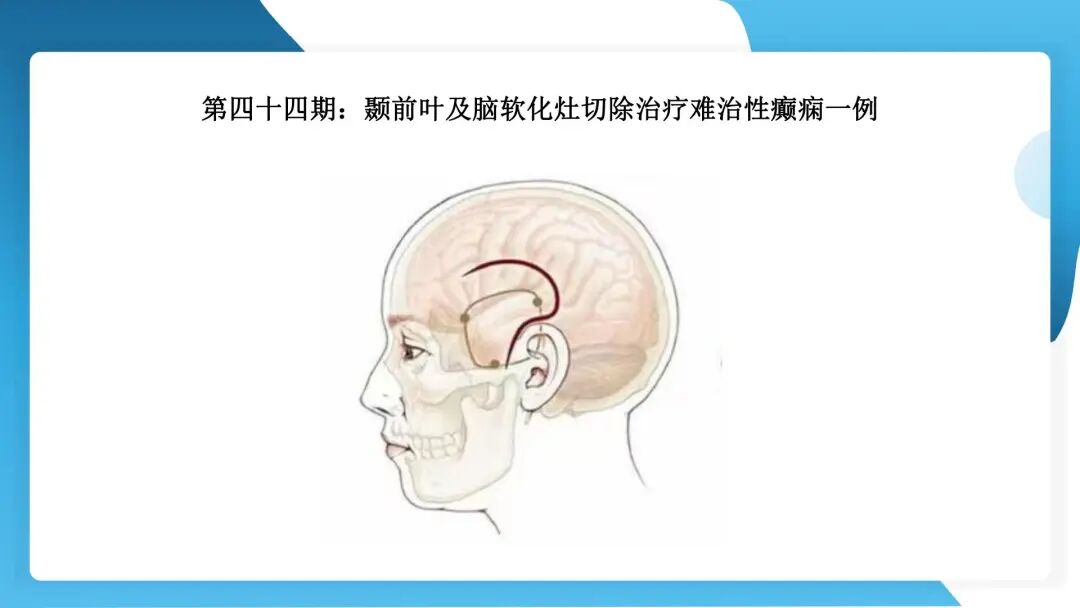 《「痫停」信步》癫痫治疗病例荟萃第四十四期---颞前叶及脑软化灶切除治疗难治性癫痫一例