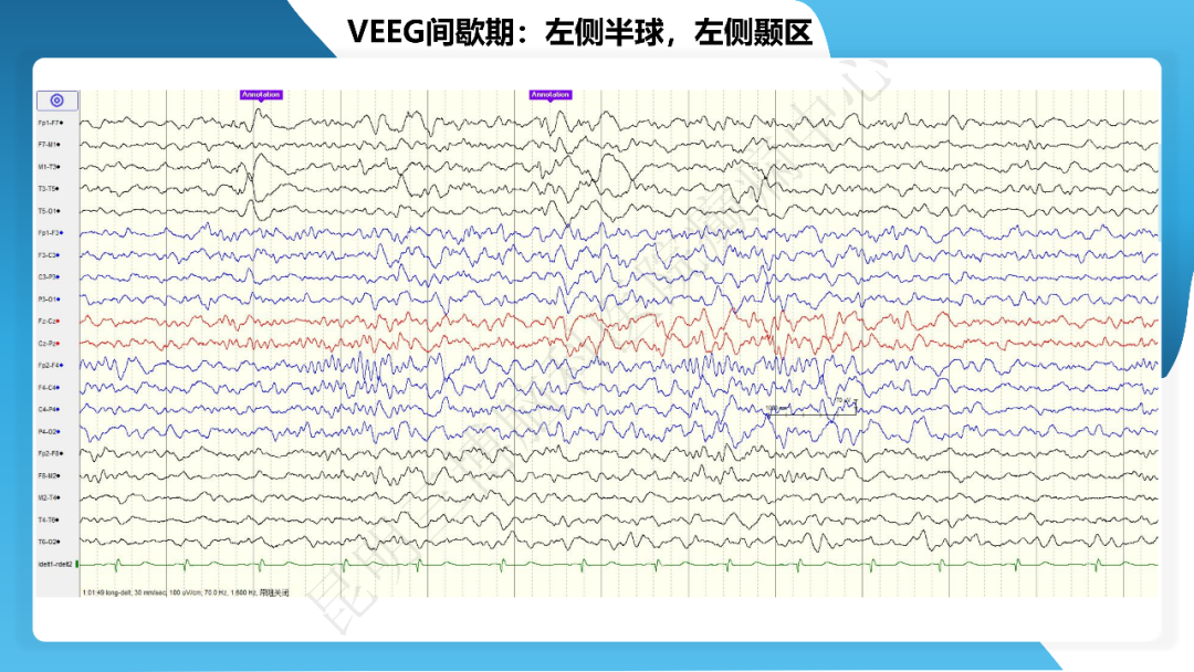 《「痫停」信步》癫痫治疗病例荟萃第四十三期---左侧颞前叶及内侧结构切除手术治疗局灶性癫痫一列