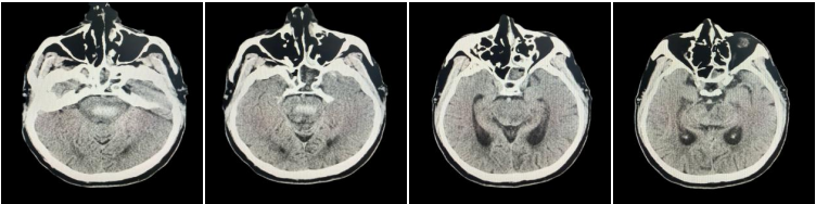 中西医并重，突破「生命禁区」！长治市中医医院成功救治重症脑干出血患者