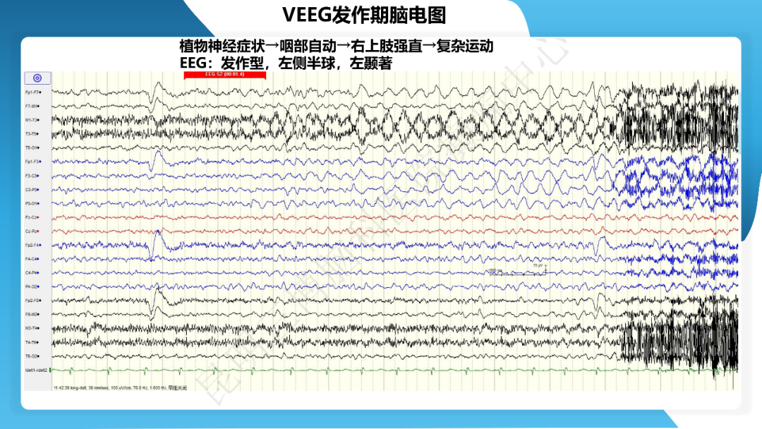 《「痫停」信步》癫痫治疗病例荟萃第四十三期---左侧颞前叶及内侧结构切除手术治疗局灶性癫痫一列