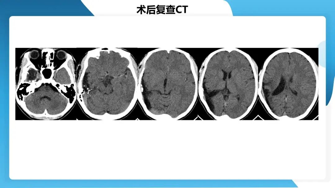 《「痫停」信步》癫痫治疗病例荟萃第四十四期---颞前叶及脑软化灶切除治疗难治性癫痫一例