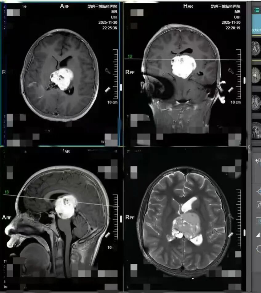 13 岁男孩确诊脑癌到昏迷仅 13 天！几个月前就有症状，很多人忽视了
