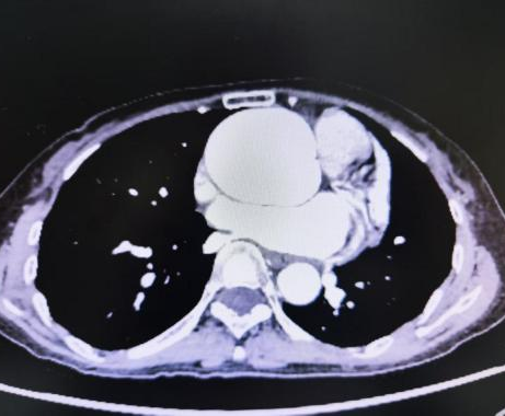 【聚焦临床前沿 170】胸膛血管扩张,「撑」成 6 cm「气球瘤」!高难度 Bentall 手术重建生命通道