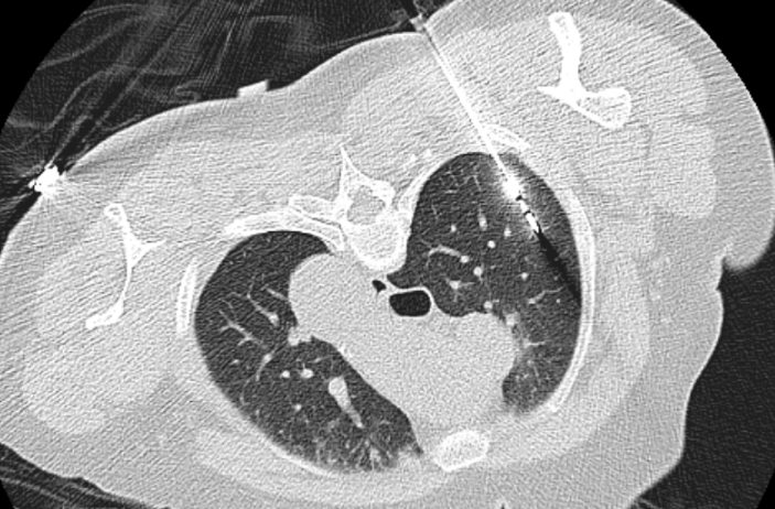 人工智能机器人「一针到位」消融肺结节!广西医科大一附院心胸外科再突破