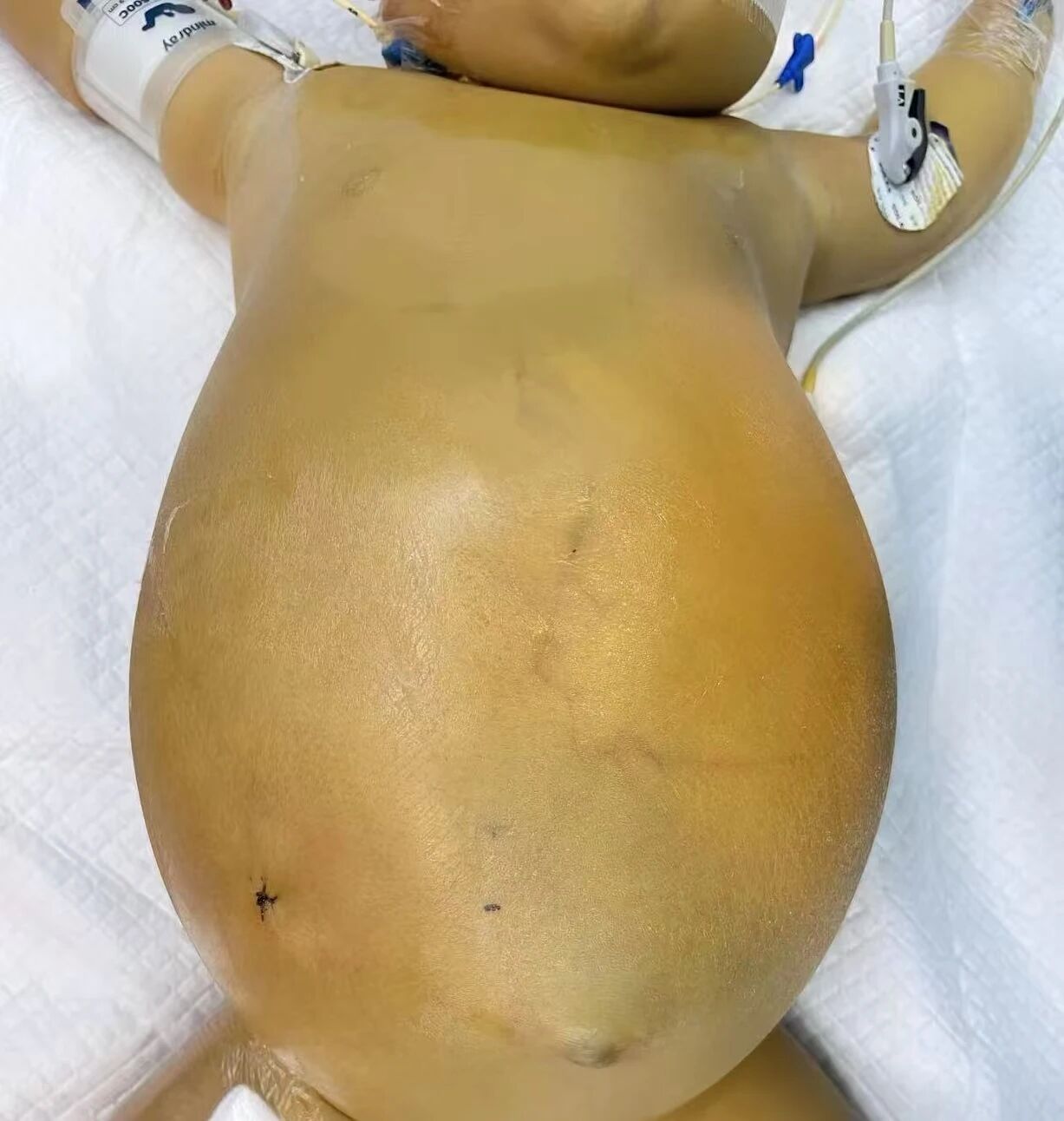 从「割肝救女」到「一肝两用」……被这些儿童肝移植故事治愈了