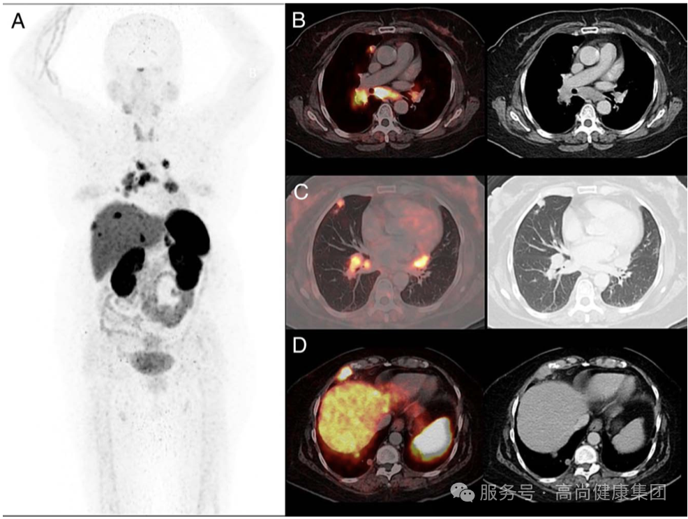 学术荟萃系列专题 | 生长抑素受体显像技术——神经内分泌肿瘤诊断利器
