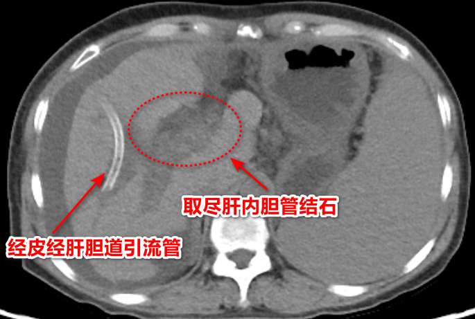 肝内胆管布满结石，别怕「大刀+大痛」，精准微创也能「清仓」！