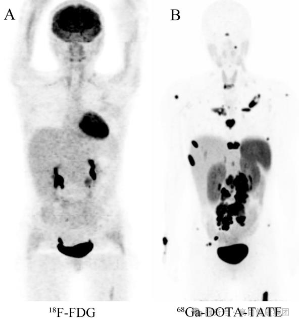 学术荟萃系列专题 | 生长抑素受体显像技术——神经内分泌肿瘤诊断利器