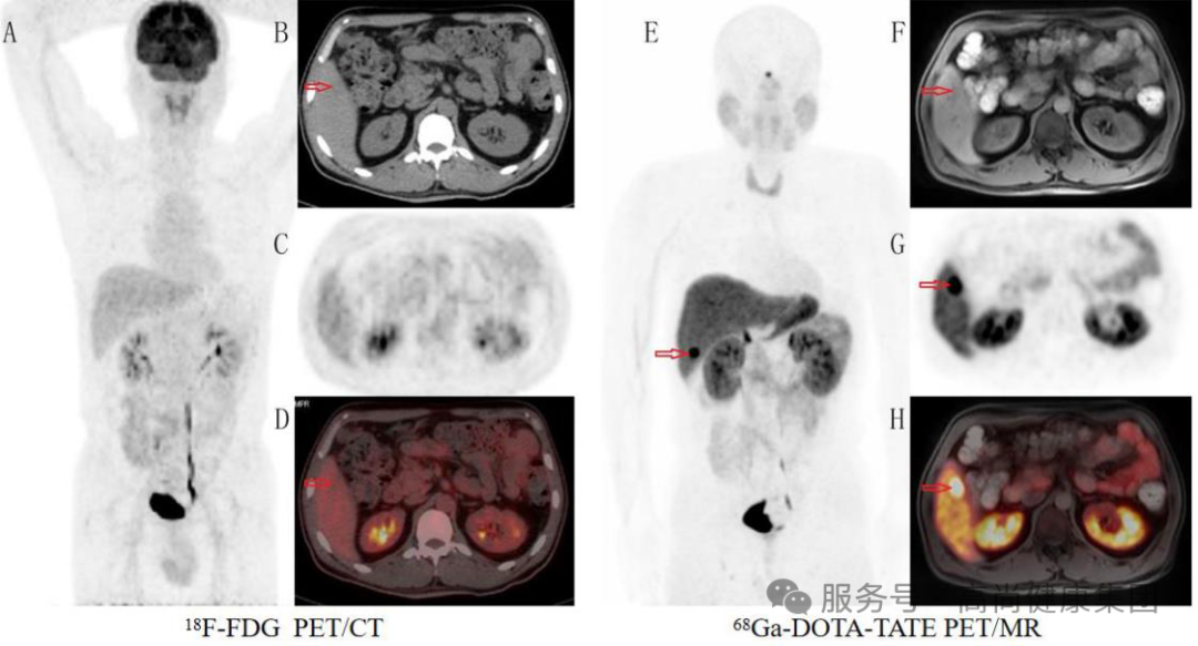 学术荟萃系列专题 | 生长抑素受体显像技术——神经内分泌肿瘤诊断利器