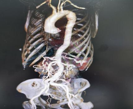 【聚焦临床前沿 170】胸膛血管扩张,「撑」成 6 cm「气球瘤」!高难度 Bentall 手术重建生命通道