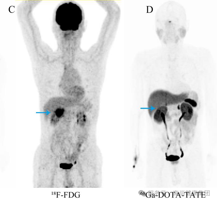 学术荟萃系列专题 | 生长抑素受体显像技术——神经内分泌肿瘤诊断利器