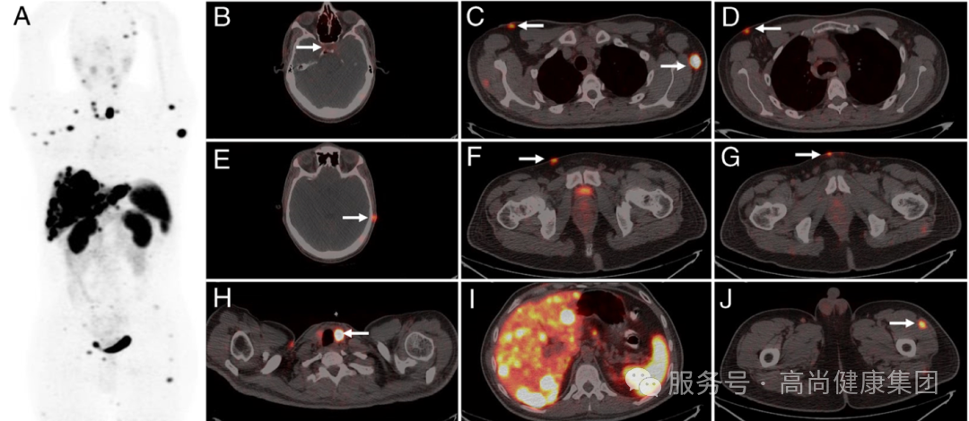 学术荟萃系列专题 | 生长抑素受体显像技术——神经内分泌肿瘤诊断利器