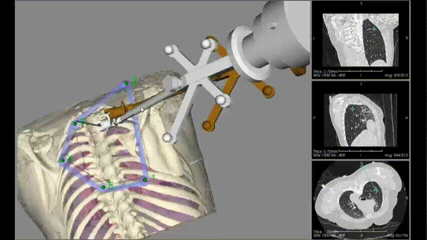 人工智能机器人「一针到位」消融肺结节!广西医科大一附院心胸外科再突破