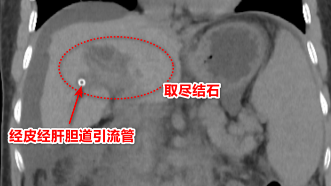 肝内胆管布满结石，别怕「大刀+大痛」，精准微创也能「清仓」！