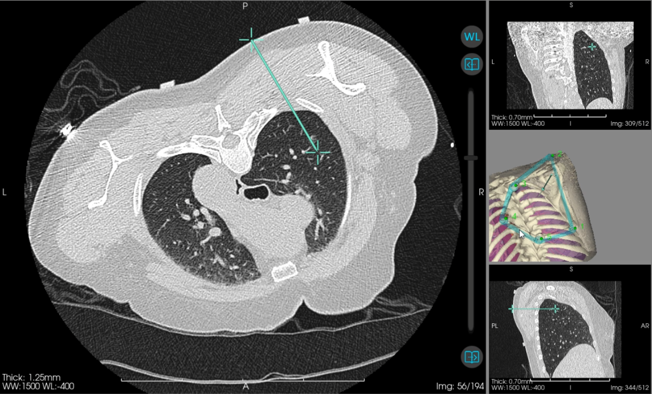 人工智能机器人「一针到位」消融肺结节!广西医科大一附院心胸外科再突破