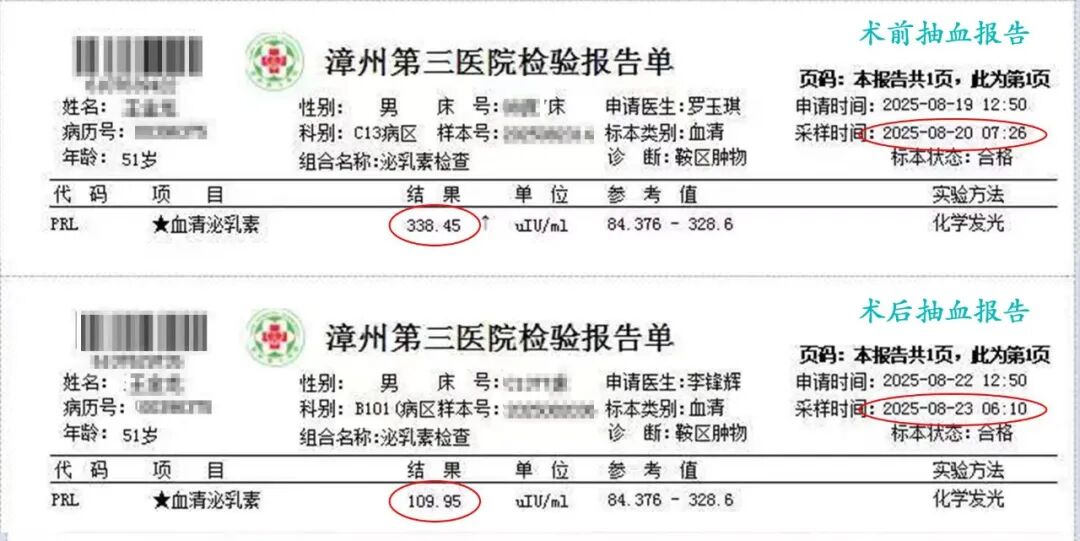 不用开颅，微创切除脑肿瘤