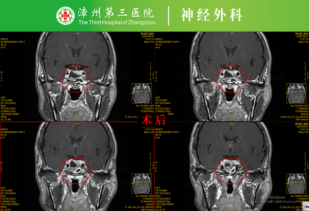 不用开颅，微创切除脑肿瘤