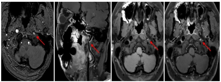 它是血管壁的「高清侦探」,可以帮你揪出脑卒中隐患